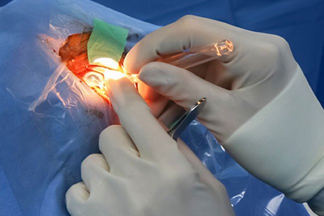 Depending on the size of the eye cancer, surgery may or may not be recommended. 