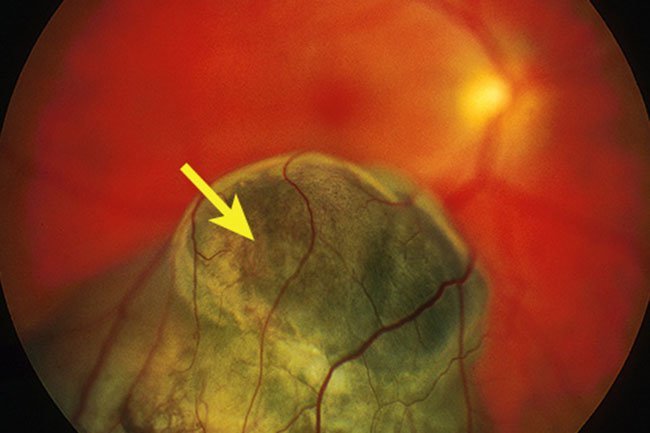 The most common type of primary eye cancer is uveal melanoma. 
