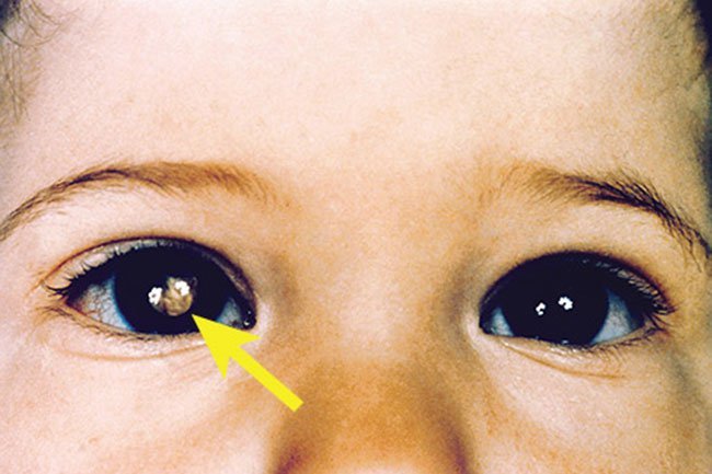 Retinoblastoma is usually found in children before the age of 5. 