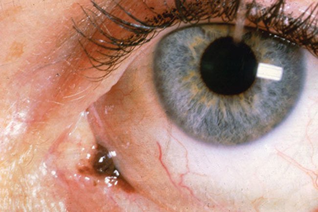 Cancer may form in the conjunctiva that lines the outside of the eyeball. 