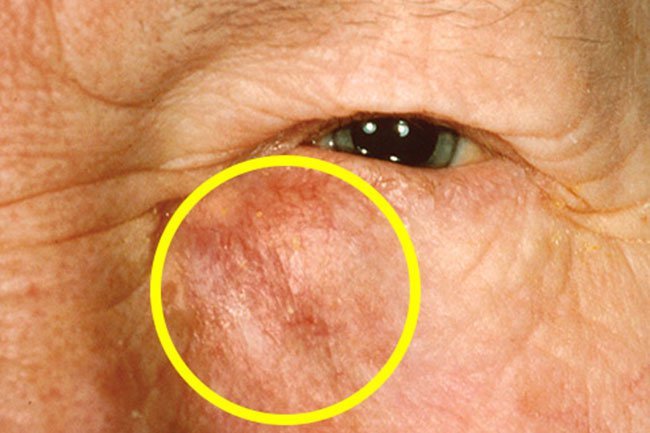 Cancer that starts in the tear ducts is called lacrimal gland cancer. 
