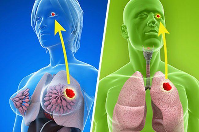 Certain types of cancers may start elsewhere and spread to the eye. 