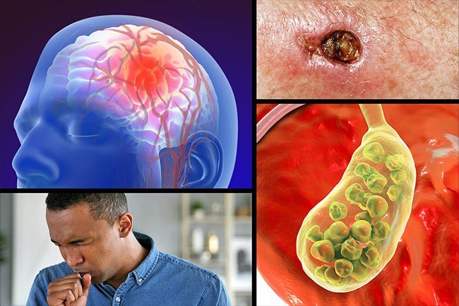 Sickle cell disease can lead to strokes, high blood pressure, and other symptoms. 