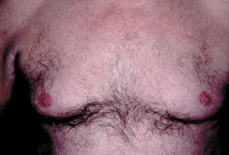 Picture of Gynecomastia