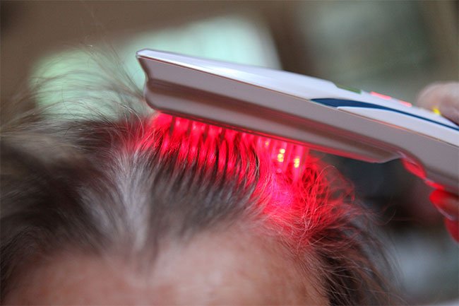Low-dose laser therapy is being used under several names as a treatment for genetic baldness. 