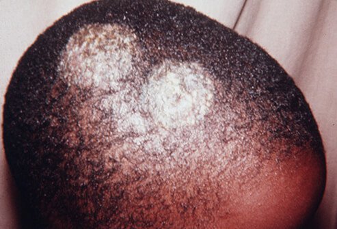 Tinea capitis, or ringworm of the scalp, is a fungal infection that tends to attack hair shafts and follicles leading to hair loss.