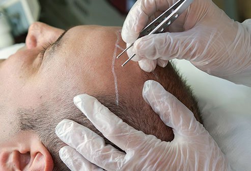 A hair transplant is typically done as an out-patient procedure in the doctor's office