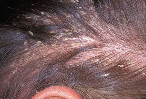 Probably the most common rash present in adults is seborrheic dermatitis.