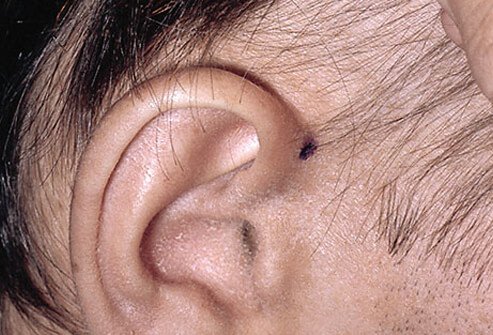 Occasionally, a large proportion of the scalp follicles begins to grow synchronously and so are in the same phase of the hair cycle.
