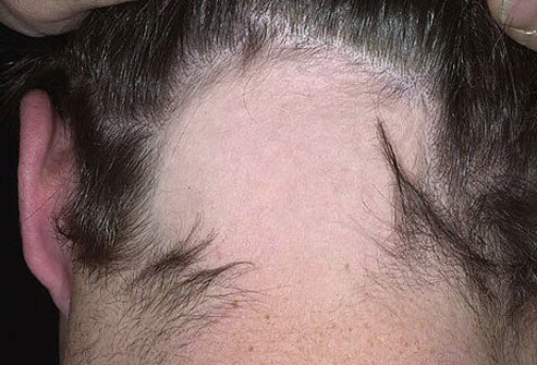 Alopecia areata is an autoimmune disease where the body attacks a group of hair follicles usually no larger than 1 inch or 2 in diameter.