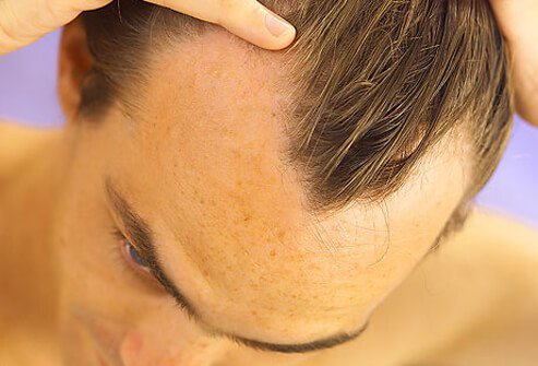 Normal hair thinning (resulting from follicular miniaturization) involving the temples, frontal hairline, and crown of the scalp, known as pattern alopecia, occurs in almost everyone as they age.