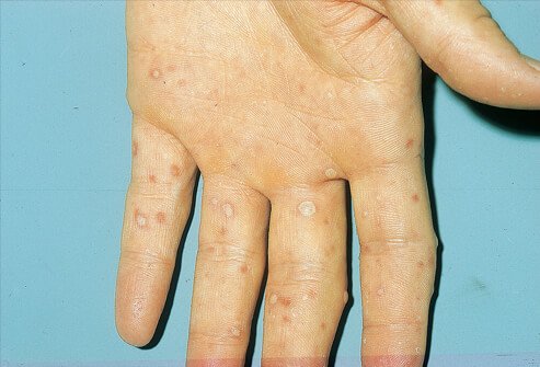 Picture of characteristic rash and blisters of hand, foot, and mouth disease