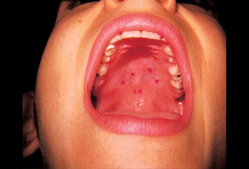 Picture of characteristic mouth sores of hand, foot, and mouth disease