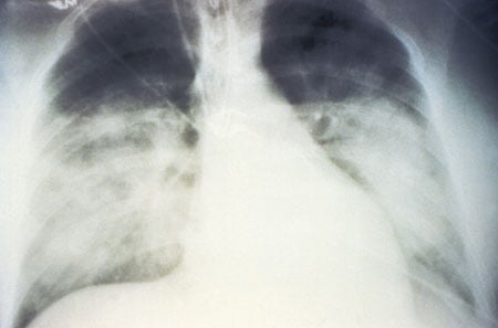 Chest X-ray of a patient with hantavirus pulmonary syndrome (HPS) Chest X-ray of a patient with hantavirus pulmonary syndrome (HPS)