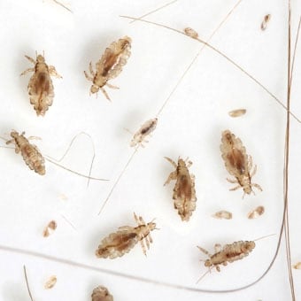 A head lice infestation amongst strands of hair.