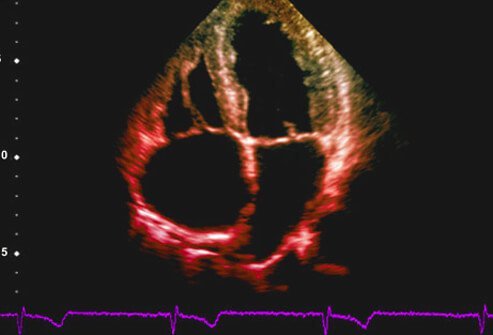 Heart failure results in the heart having difficulty pumping sufficient blood throughout the body.