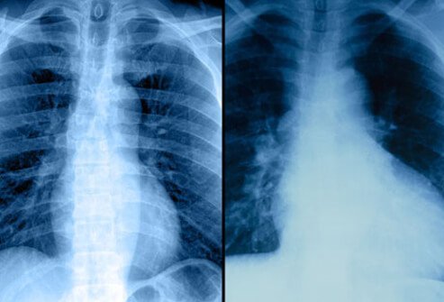A chest X-ray can help determine if someone has an enlarged heart or buildup of fluid in the lungs due to heart failure.