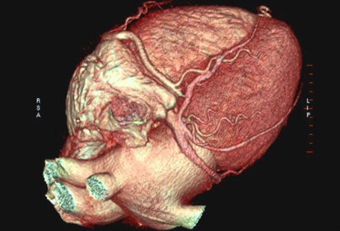 A cardiac CT scan shows calcium buildup in the coronary arteries for those at increased risk of heart disease and heart attack.