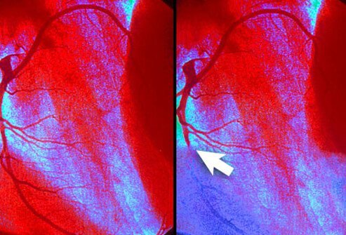 Reduced blood flow to the heart (Arrow) causes the telltale heart disease symptom, angina.