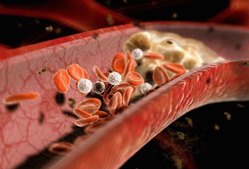 Ruptured plaques may trigger the formation of clots that block arterial blood flow.