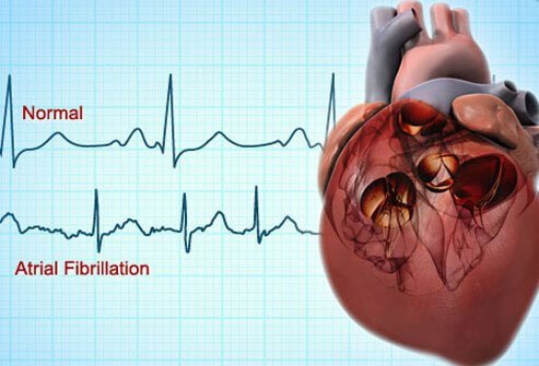 Arrhythmias are another type of heart disease that may increase the risk of a heart attack or stroke.