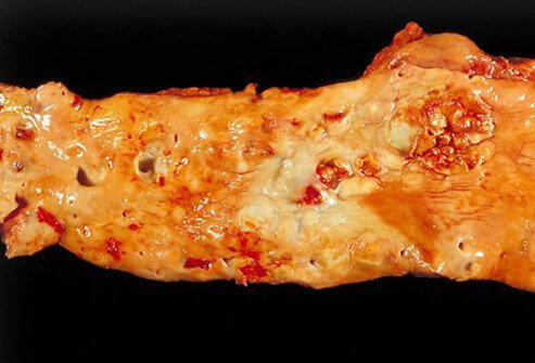 Coronary artery disease (CAD), commonly known as heart disease, is a condition in which cholesterol, calcium, and other fats accumulate in the arteries that supply blood to the heart.