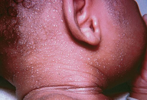 This is common when children are overdressed, bundled up for cold weather, or have a fever.