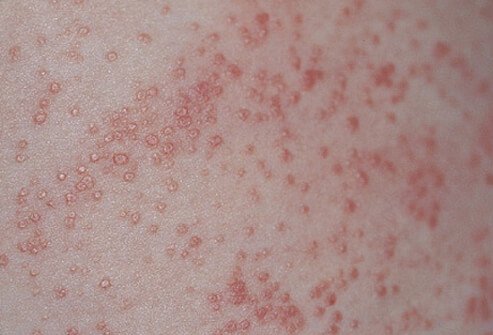 Common symptoms of heat rash are red bumps on the skin, and an itchy or prickly feeling to the skin.