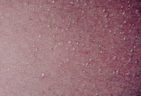 It is usually very mild and doesn't produce many uncomfortable symptoms.