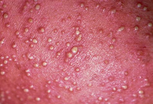 These pustules may be the first signs of a skin infection and should be checked by your doctor.