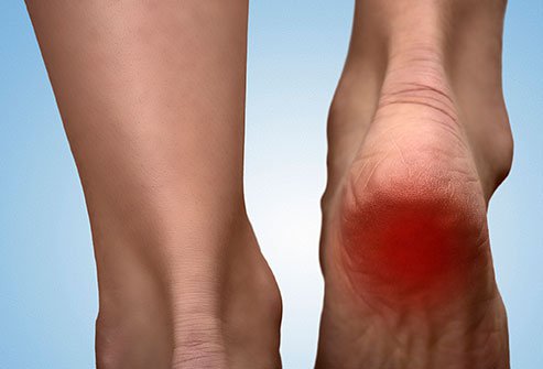 Heel pain can be caused by abnormalities in your walking gait that stress the heel bone and the soft tissues attached to it. The fastest way to cure heel pain involves diagnosing and treating the cause of the problem whether it is due to plantar fasciitis, heel spurts or other problems.