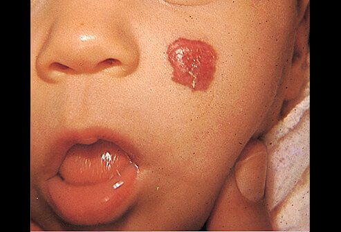 Picture of Hemangioma