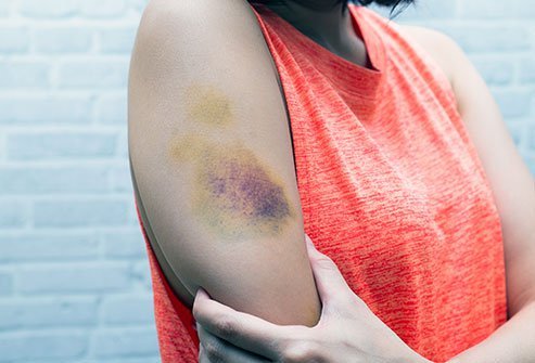A hematoma may have no visible signs, but a bruise will appear as localized discoloration.