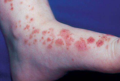Henoch-Schonlein purpura (HSP)