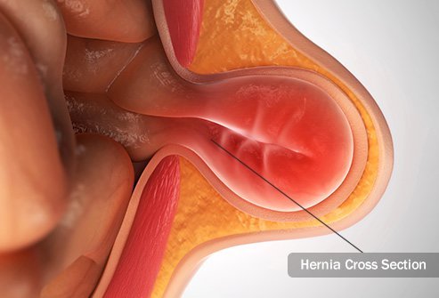 A hernia occurs in an area where the muscle wall is weak. 