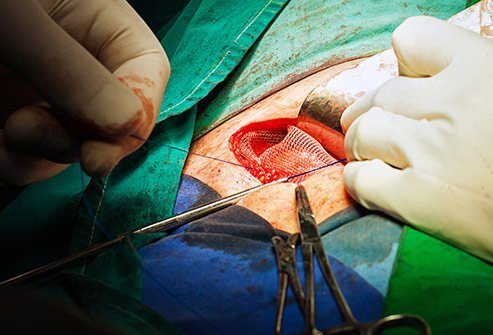 A special mesh implanted surgically may help support the abdominal wall. 