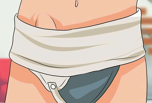 A truss may give you extra support but it won't heal your hernia. 