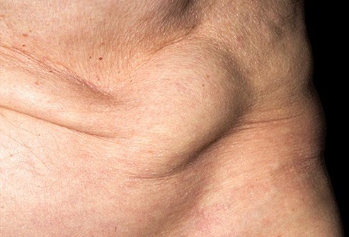 Hernias may always be visible or only when you strain or lift something heavy.