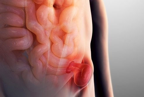 Inguinal hernias are the most common kind of hernia. 