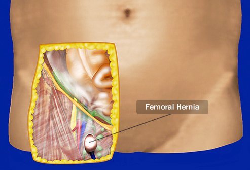 Femoral hernias are less common than inguinal hernias. 