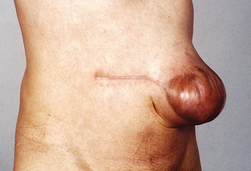 An incisional hernia happens in an area where you had surgery.