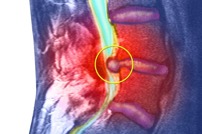 A herniated disk pushes on a nearby nerve. 