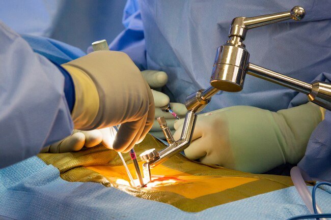 Some people may need to consider surgery if their symptoms are not resolving after 6 weeks of other treatments.