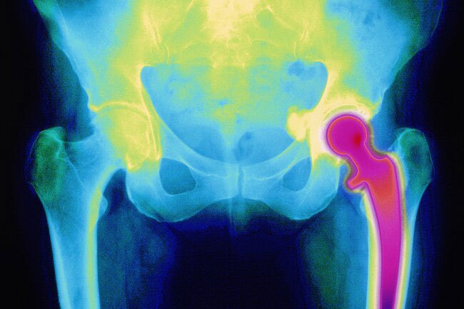 Hip replacement is an operation to repair a damaged hip joint.