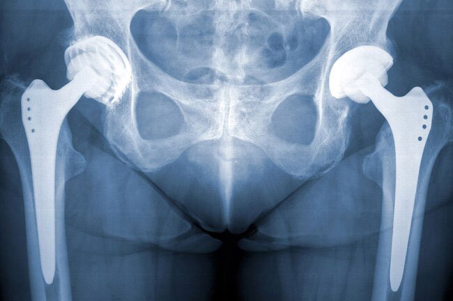If you need both hips replaced, your surgeon may want to do them at the same time.