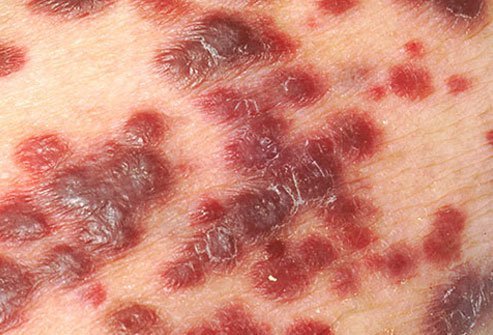 Kaposi’s sarcoma is a skin cancer that may develop in AIDS patients. 