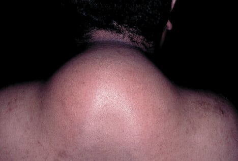Picture of HIV Lipodystrophy.