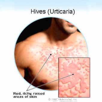 An illustration of hives, also known as urticaria.