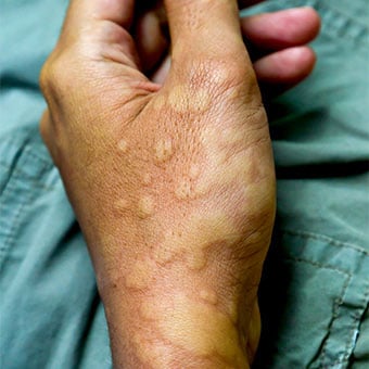 A hand covered in hives.