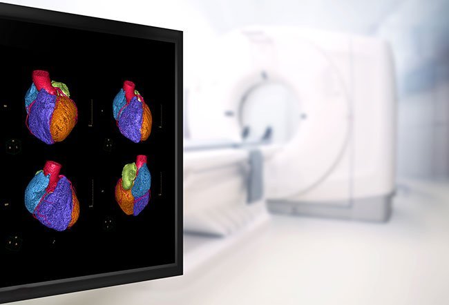 A mycocardial perfusion scan is an imaging study that shows how well blood flows through the heart muscle. The sensitivity, specificity and accuracy of cardiac imaging with single-photon emission computed tomography (SPECT) is between 44 percent and 70 percent depending on the blood vessels involved. 